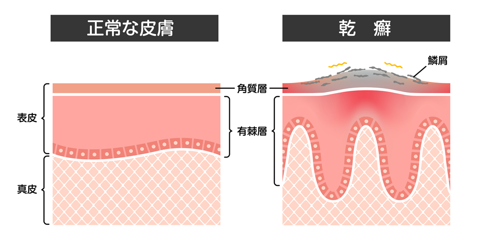 乾癬とは